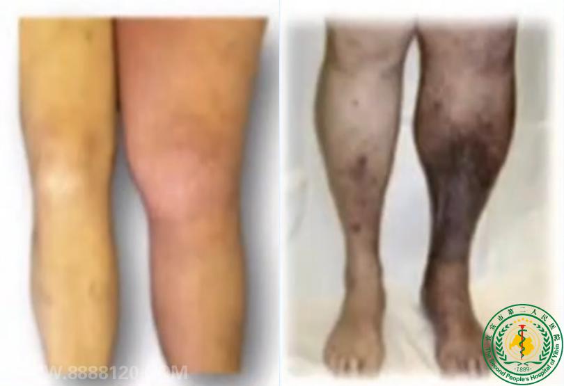 ��֫������ʹ��ע��������ľ���ѹ���ۺ���