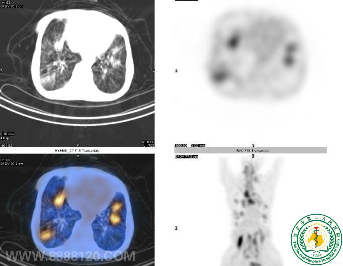 ӥPET/CT᳦ֽCaദתһ