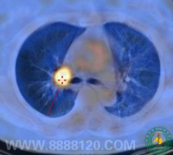 ԺPET/CT һĻع